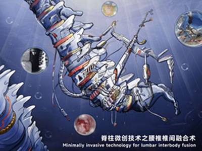 2022年第6期重點專題 | 脊柱微創技術之腰椎椎間融合術